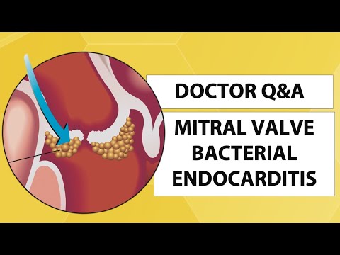Mitral Valve Bacterial Endocarditis: What Should Patients Know?