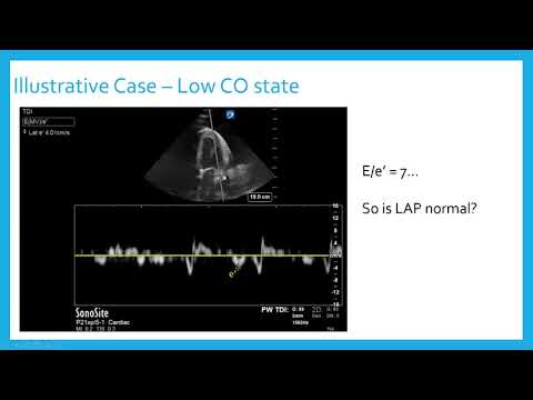 Diastology Tips, Tricks, and Example Cases - Critical Care Echocardiography Review