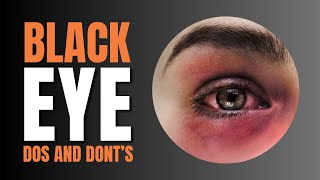 Download lagu 👁️‍🗨️ Black Eye Survival Guide || Do’s and Don’ts for a Speedy Recovery mp3