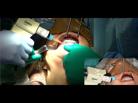 All-on-4® nSequence® Implant Surgical Technique Using Zest Chairside® Attachment Processing Material