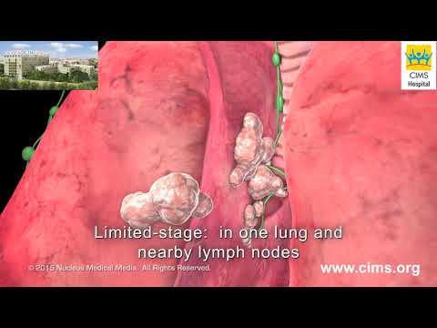 Small Cell Lung Cancer Staging – CIMS Hospital