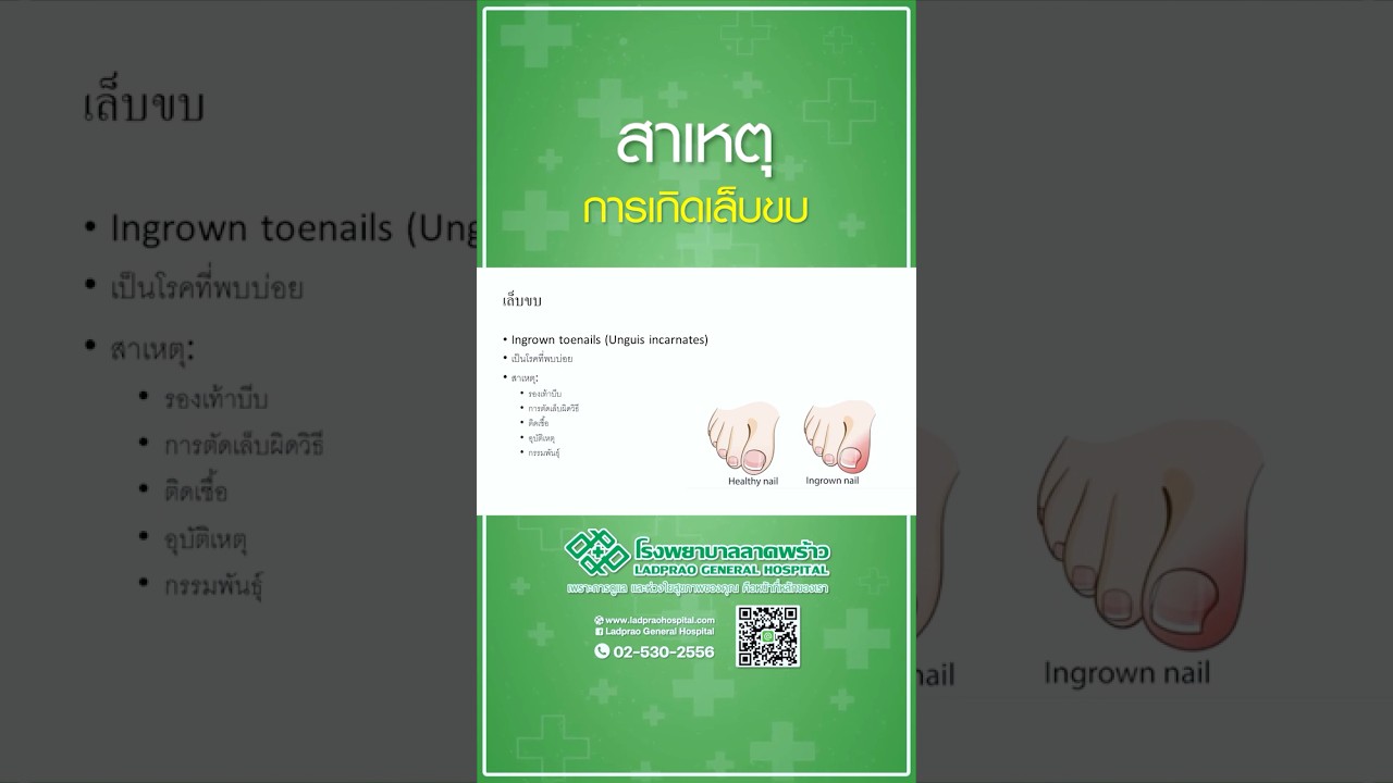 สาเหตุการเกิดเล็บขบ  #โรงพยาบาลลาดพร้าว #เล็บขบ #สาเหตุการเกิดเล็บขบ #ตัดเล็บผิดวิธี