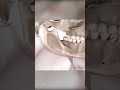 Corrective Jaw Surgery Orthognathic Surgery