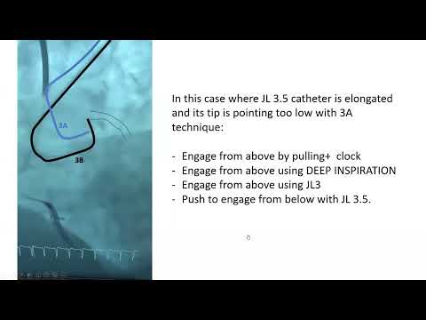 Left coronary engagement simple technique (triple maneuver)