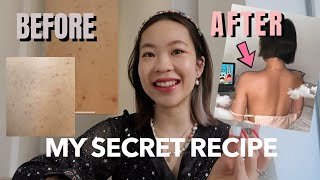 HOW I CURED MY BACK ACNE (Before/After Photos) | Euodias