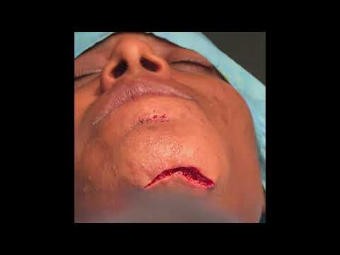 Giant Hemangioma Removal Surgery