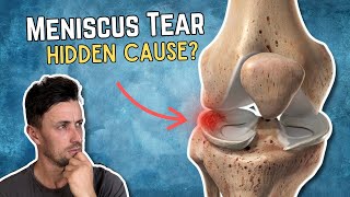 Meniscus Tears: A Consequence of Something Else?