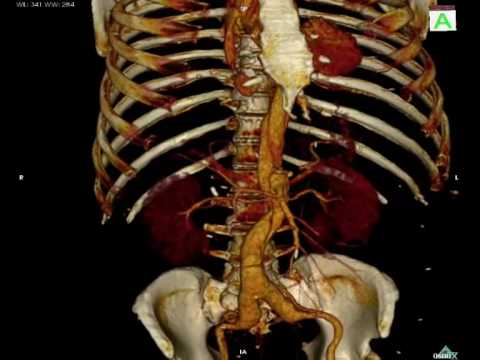 Virtopsy - CT angiography (Volume Rendering)