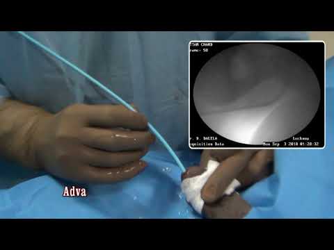 Dilatación de la estenosis uretral