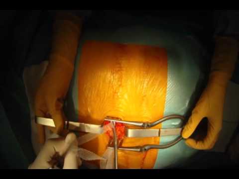 Schäden an der Wirbelsäule und des Beckens Diagnose und Behandlung Kann trockene Kehle Osteochondrose