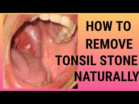 Tonsil stone remedy forever | How to remove tonsil stone naturally | Get rid of tonsil stone at home