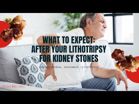 What to expect after your Lithotripsy procedure for Kidney Stones (2020) | ESWL / Shockwave Therapy