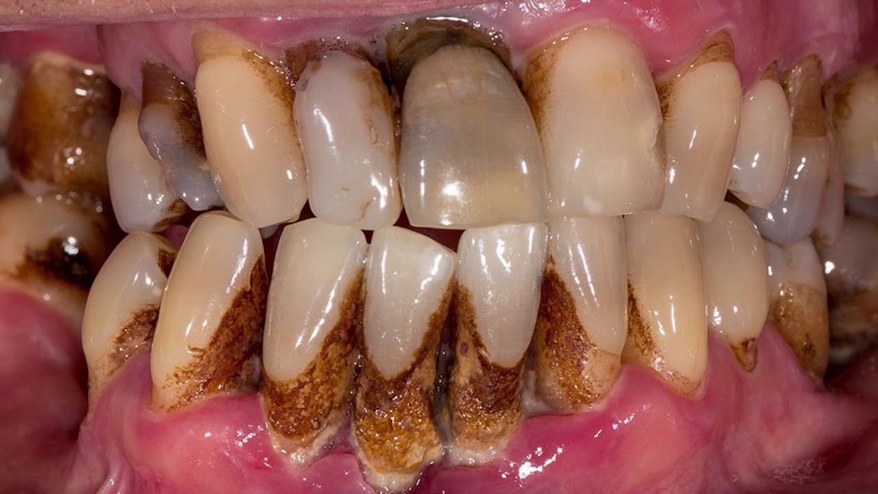 Пародонтит