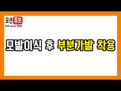 [비절개모발이식]부분삭발방식 모발이식 후 부분가발 착용 방법 및 전후 비교