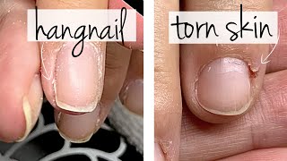 Hangnail or Torn Skin? [Do You Know the Difference?]