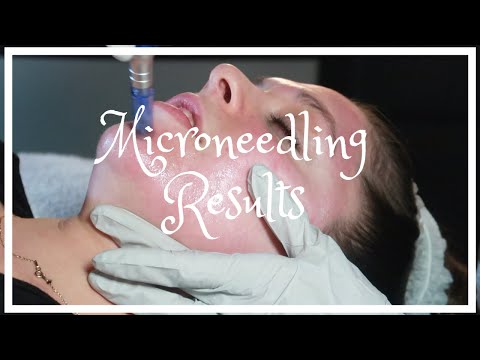 MICRONEEDLING RESULTS! WORTH IT?! MY SKIN BEFORE, DURING, AND AFTER ! POST TREATMENT DAILY UPDATES Video