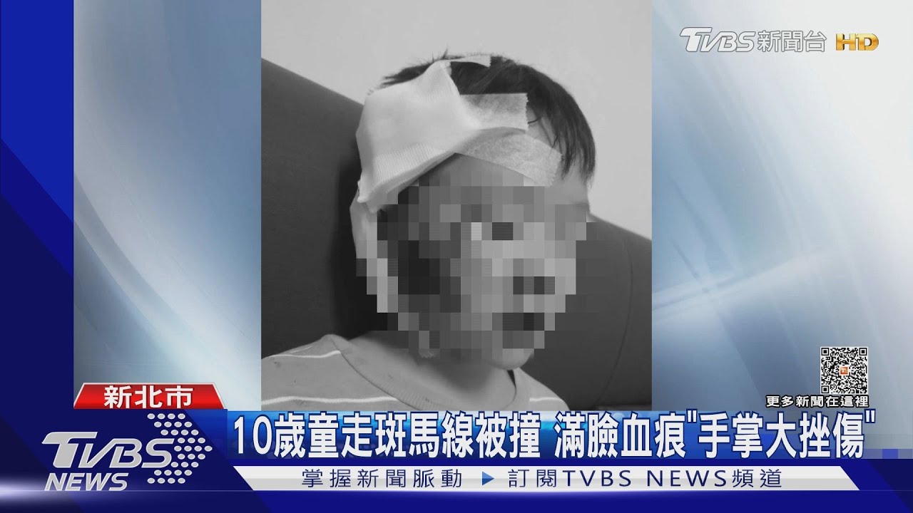 10歲童走斑馬線被撞　滿臉血痕「手掌大挫傷」