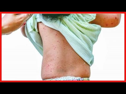 Die Komplikationen von Drei-Tage-Fieber und wie man sie verhindern kann