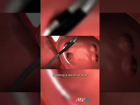 Atrial fibrillation catheter ablation