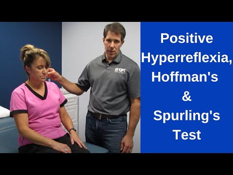 Positive Hoffman's Sign,  Hyperreflexia and Spurling's Test