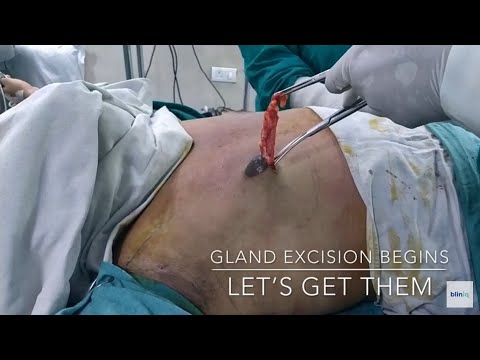 Patient Recovery Case — Video 29 (Tummy Tuck)