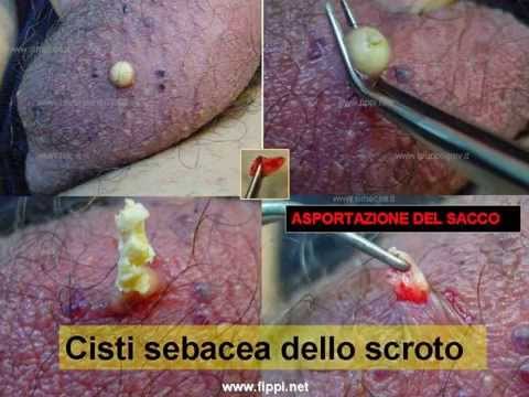 Se i vermi possono influenzare uno sfondo ormonale Verme a lungo rotondo da che