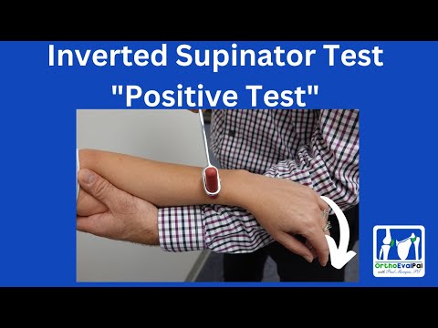 Positive Hoffman s Sign Hyperreflexia and Spurling s Test