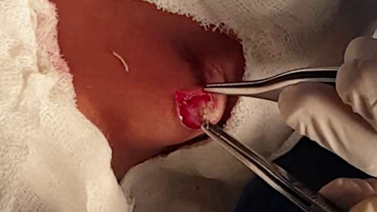 Sebaceous Cyst Excision