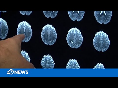 Study suggests human brain cells transplanted into a rat's can ...
