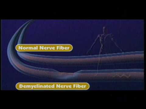 Types of Fatigue in MS - National MS Society