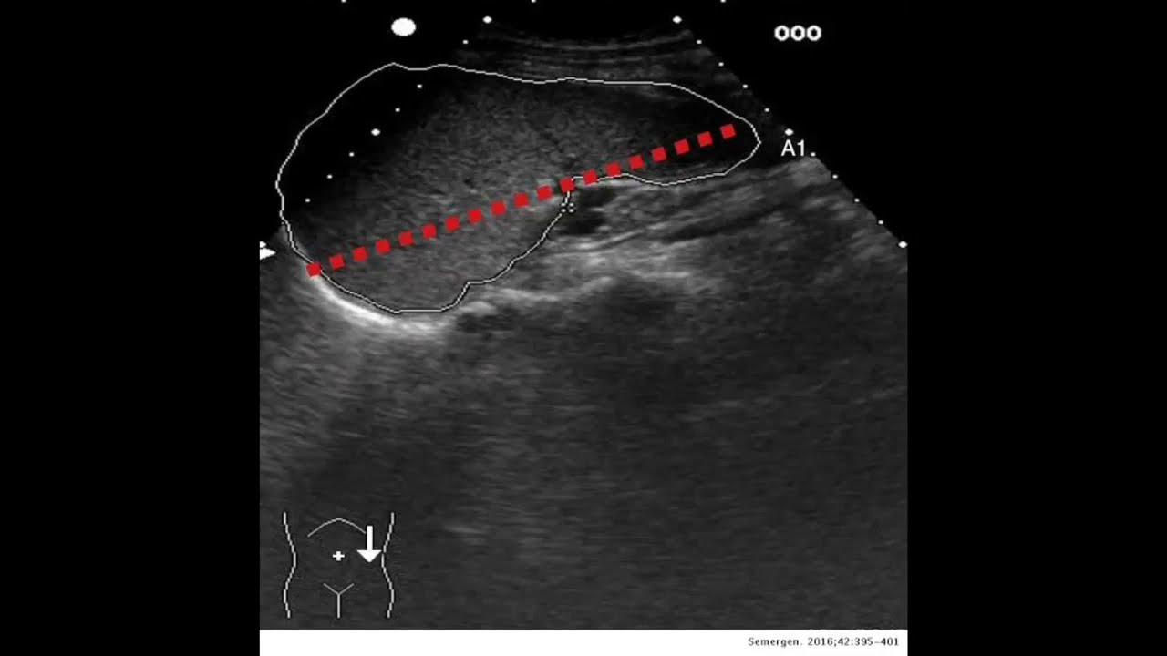 Watch ESPLENOMEGALIA VALORACIÓN POR ECOGRAFÍA BAZO CRECIDO Now ESPLENOMEGALIA VALORACIÓN POR ECOGRAFÍA BAZO CRECIDO