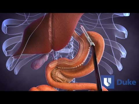 Duodenal Switch Surgery | Duke Health