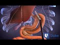 Duodenal Switch Surgery Duke Health