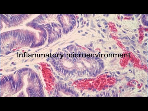 FROM HERE !  " A cradle for cancer: solving the enigma of the inflammatory microenvironment "