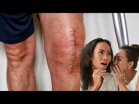 جراحة المفصل المتقدمة: رعاية دقيقة للمفاصل من أجل تعافي مثالي