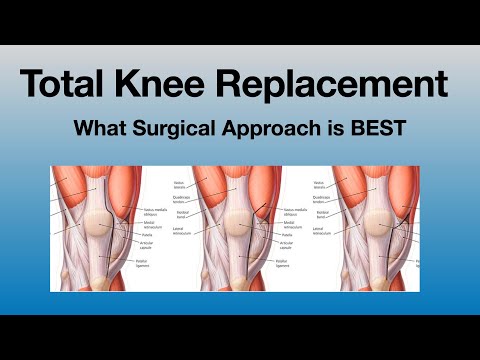 Quad-Sparing vs Traditional Knee Replacement: What to Know