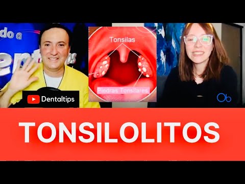 TONSILOLITOS 👄 con @Dentaltipsmx