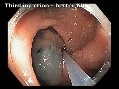 Transverse colon - Flat lesion