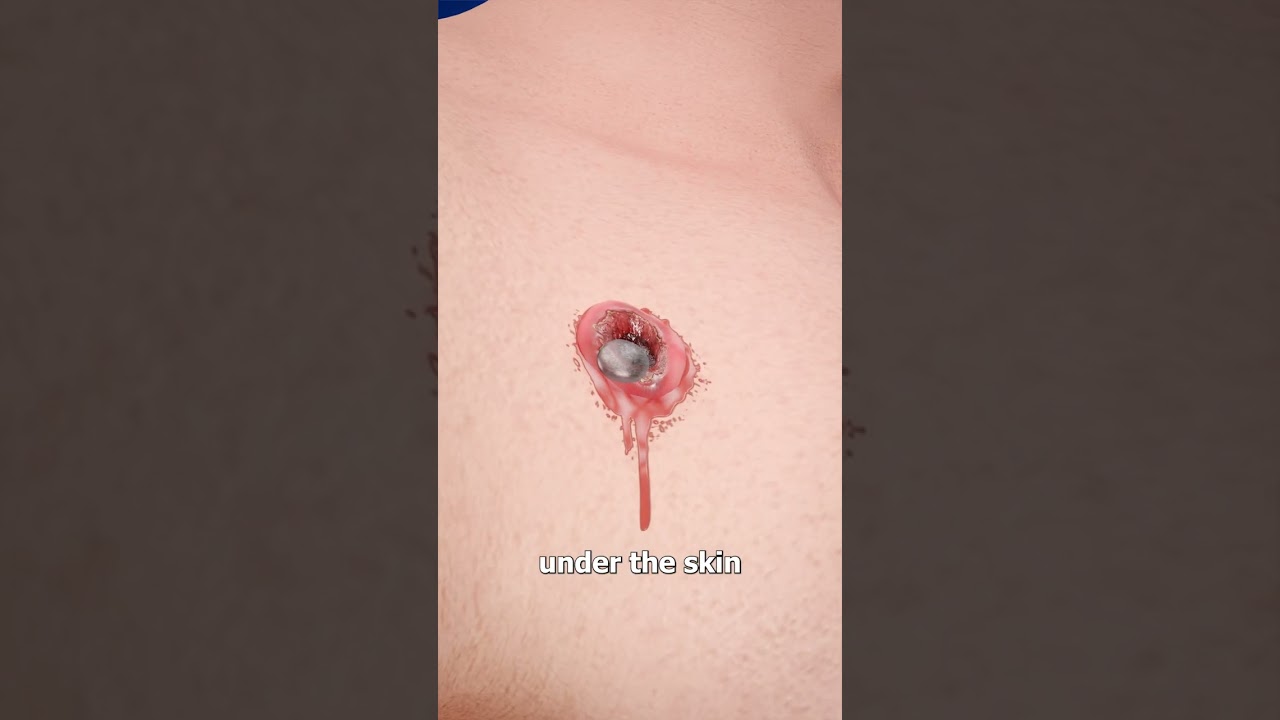 Bullet Extraction In The Civil War 😨