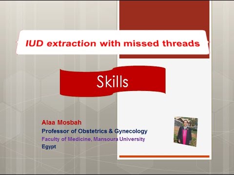 IUD extraction with missed threads