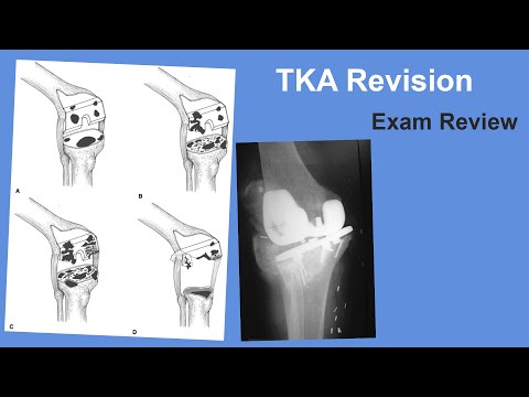 TKA Revision Exam Review - David Lewallen, MD