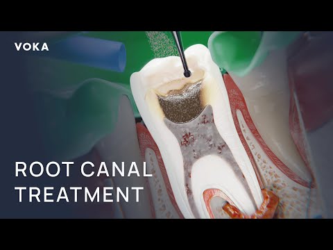 Root Canal Treatment | VOKA 3D medical animation