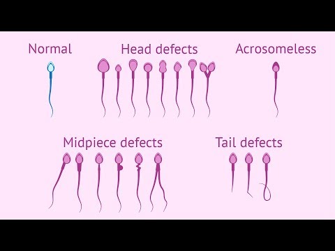 What is teratozoospermia?