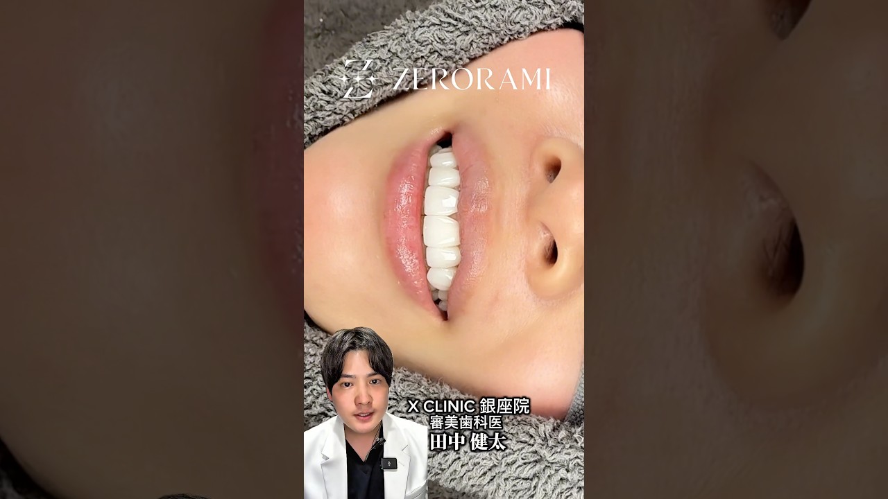 口元が変われば笑顔が変わる。笑顔が変われば人生が変わる。そ人生を豊かにする治療"ZERORAMI"🦷💎#審美歯科 #ラミネートベニア #セラミック