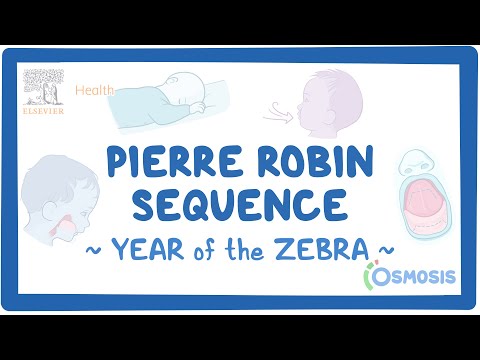 Pierre Robin Sequence (Year of the Zebra)