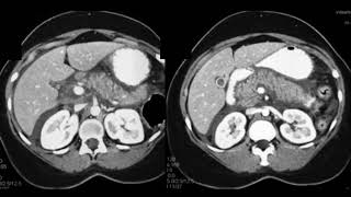 Download Lagu Evaluating Acute and Chronic Pancreatitis Part 1 Thumbnail