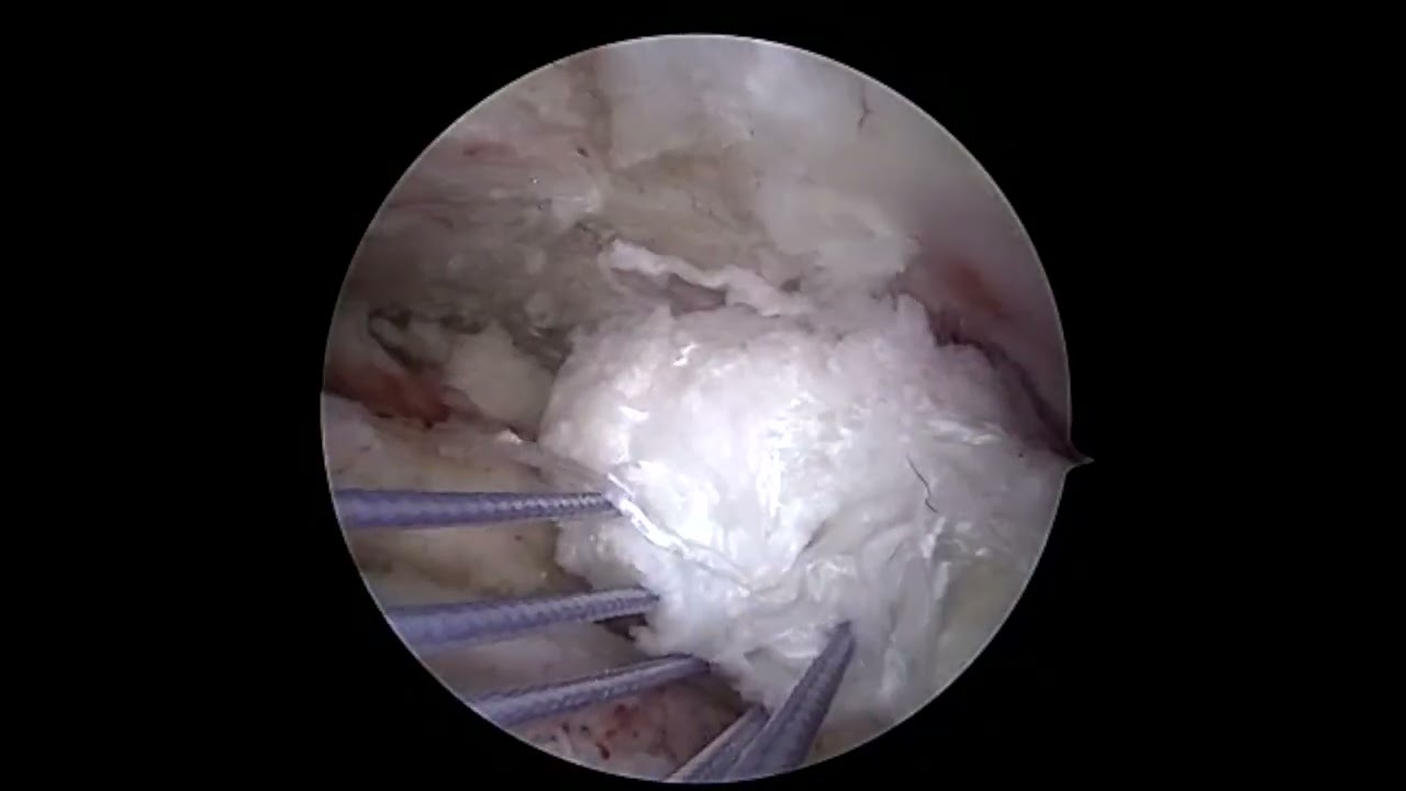 Lower Trapezius Transfer with Partial Cuff Repair