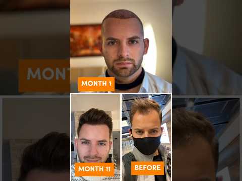 11 Months hair transplant results #shorts