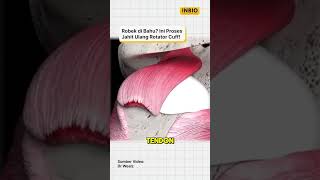 Download lagu Torn Shoulder? Here's How to Re-stitch a Rotator Cuff! mp3