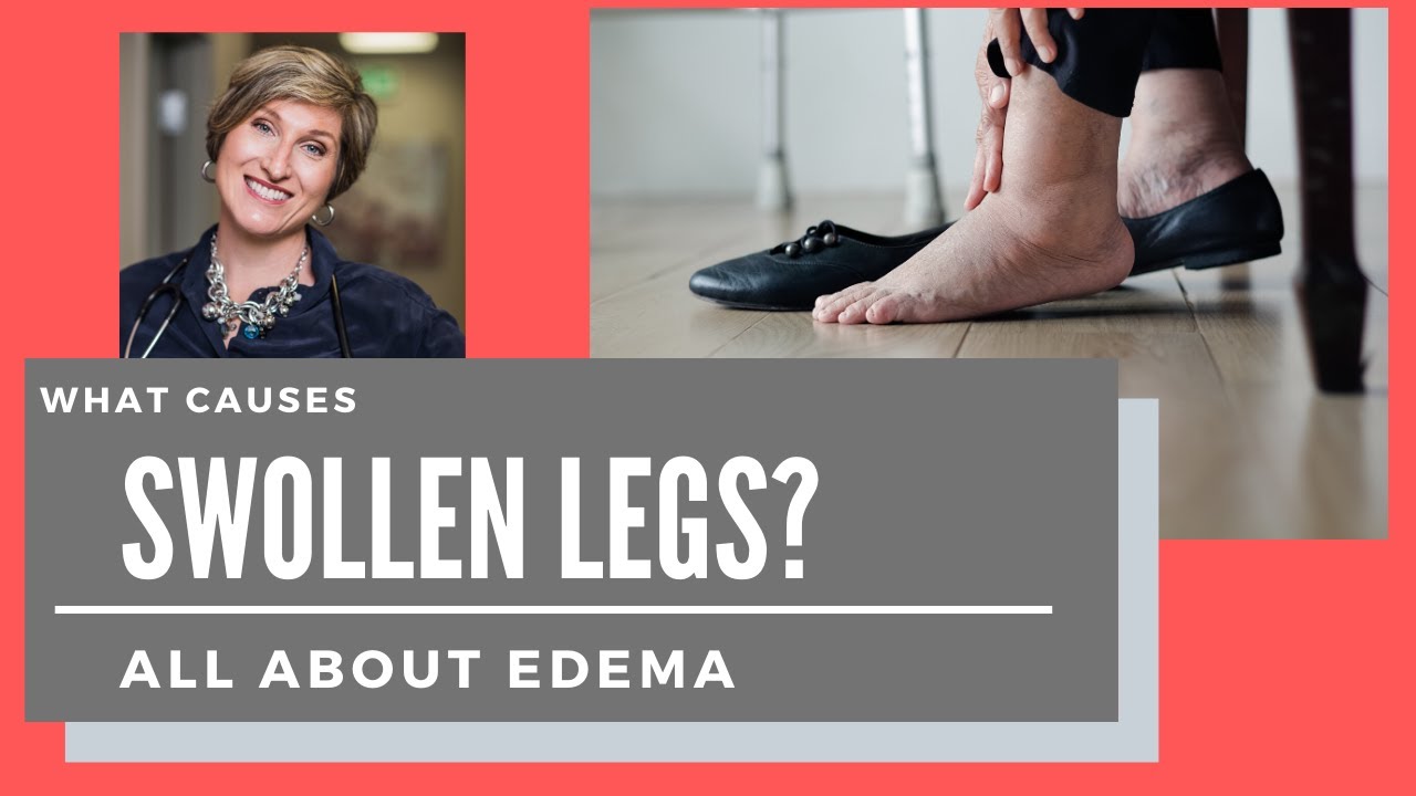 EDEMA - What causes swollen legs and feet